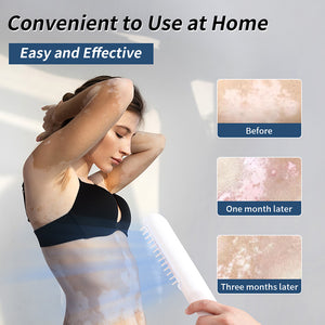 BU-1 home UVB phototherapy lamp shown in a home use demonstration