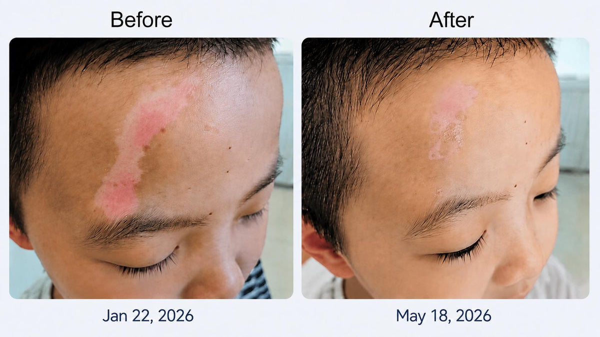 A Child’s 4-Month Vitiligo Photo Journey with Home 311nm NB-UVB