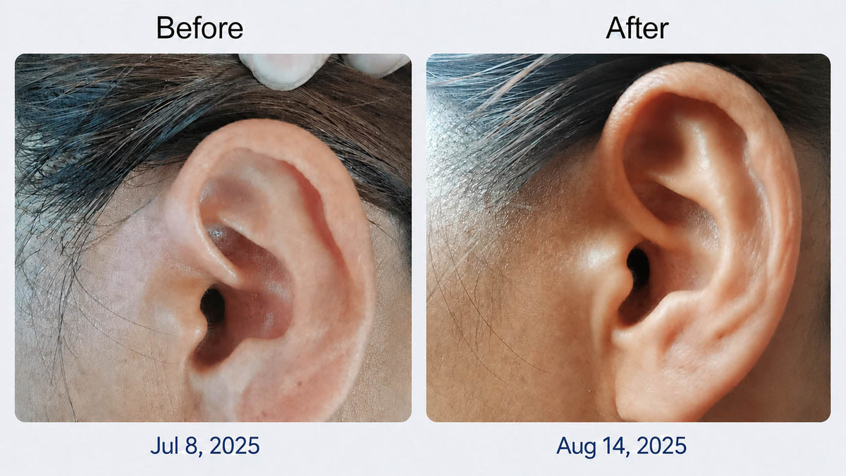 A Five-Week Vitiligo Photo Journey with Home 308nm LED UVB