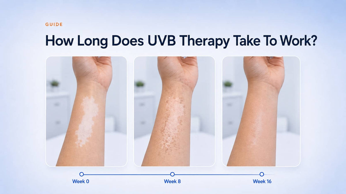How Long Does UVB Therapy Take To Work?