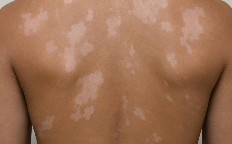 Before treatment
