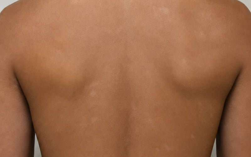 After treatment