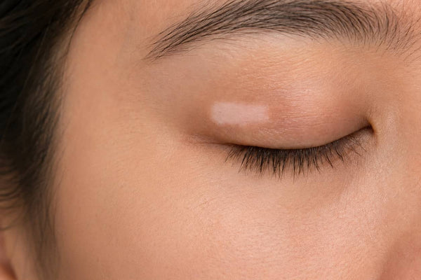 Eyelids