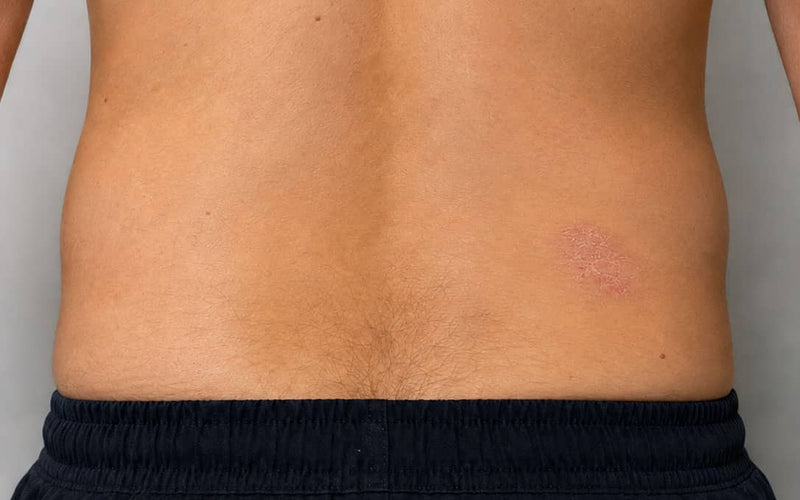 After treatment
